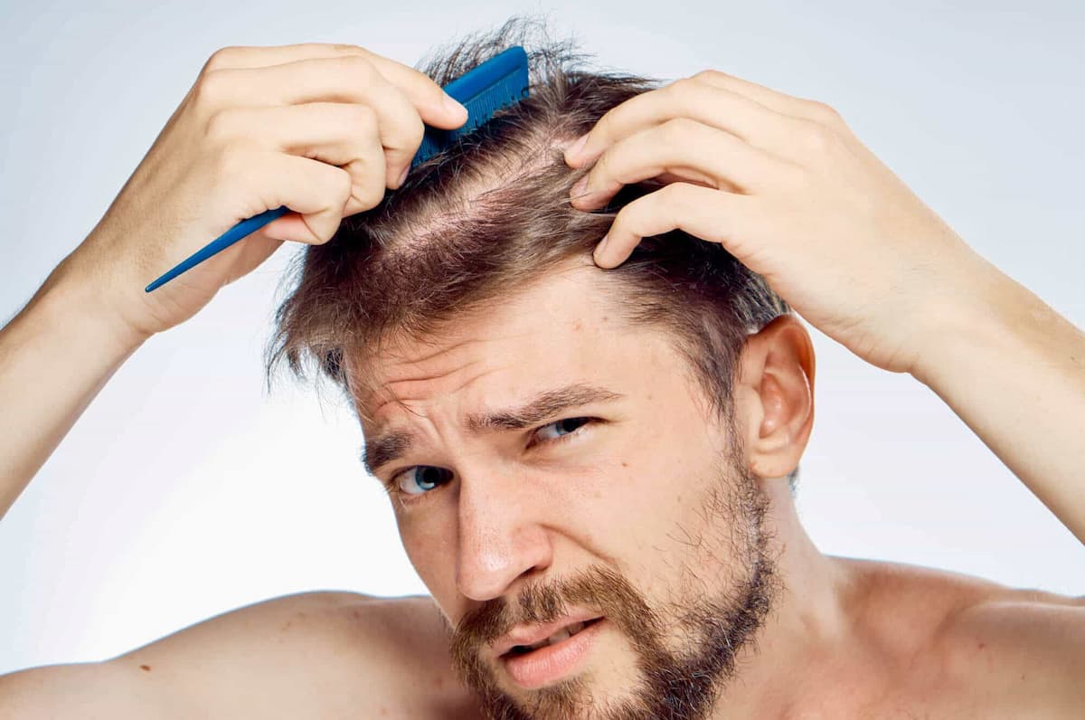 male hair loss